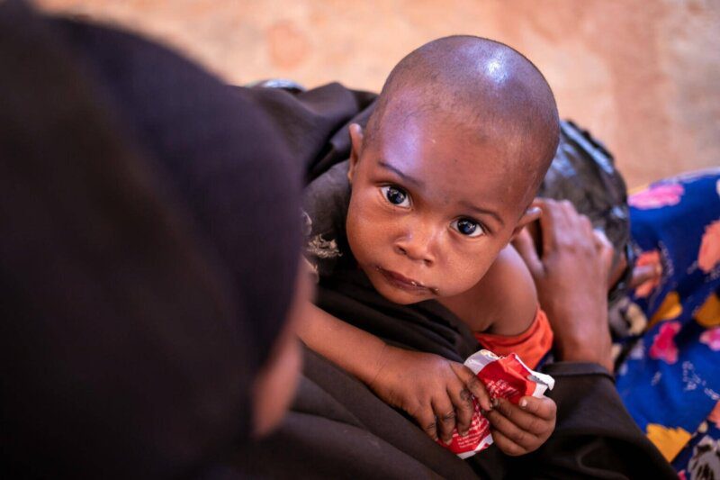 Otrok med zdravljenjem zaradi podhranjenosti, v zdravstvenem centru v Dolowu v Somaliji.