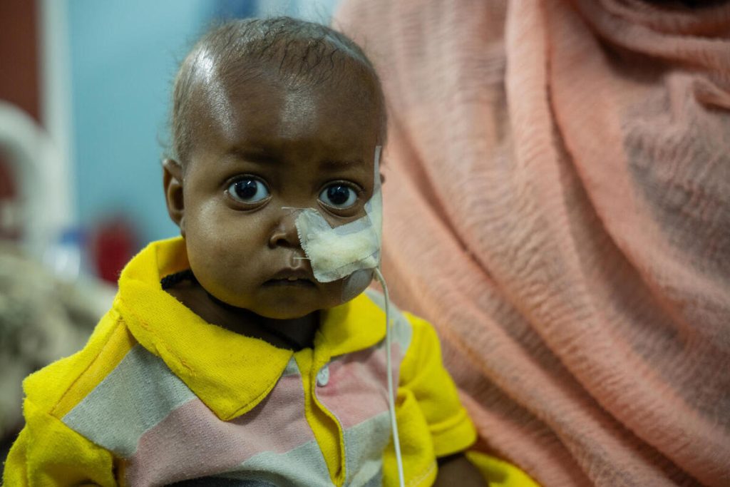 15 mesecev star Muhialdeen Mohammad iz Sudana je hudo podhranjen. V zdravstvenem centru, ki ga podpira UNICEF gleda v kamero.