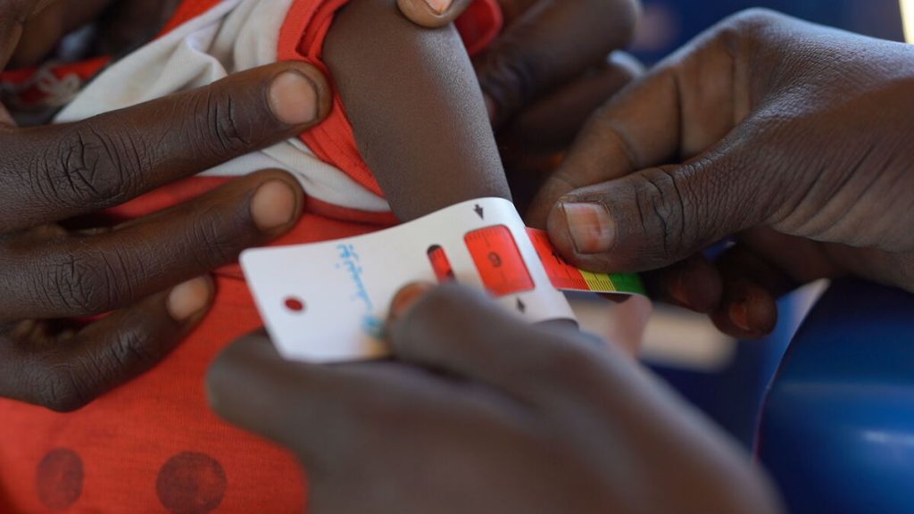 Trak za merjenje podhranjenosti kaže hudo podhranjenost na nadlahti otroka.