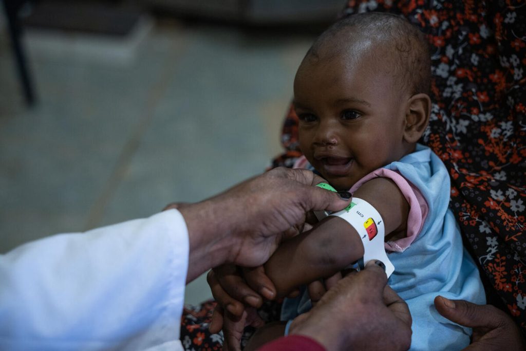 Otroku v Sudanu merijo nadlaht, da bi ugotovili podhranjenost.