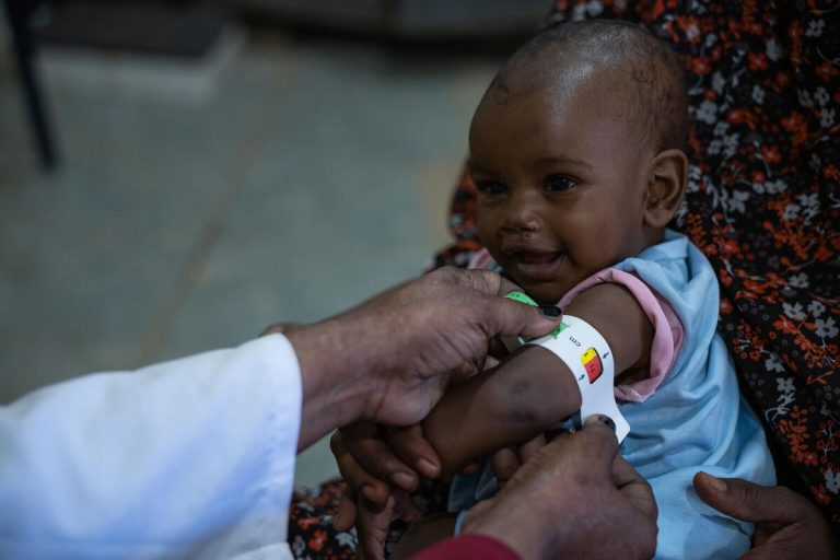 Otroku v Sudanu merijo nadlaht, da bi ugotovili podhranjenost.