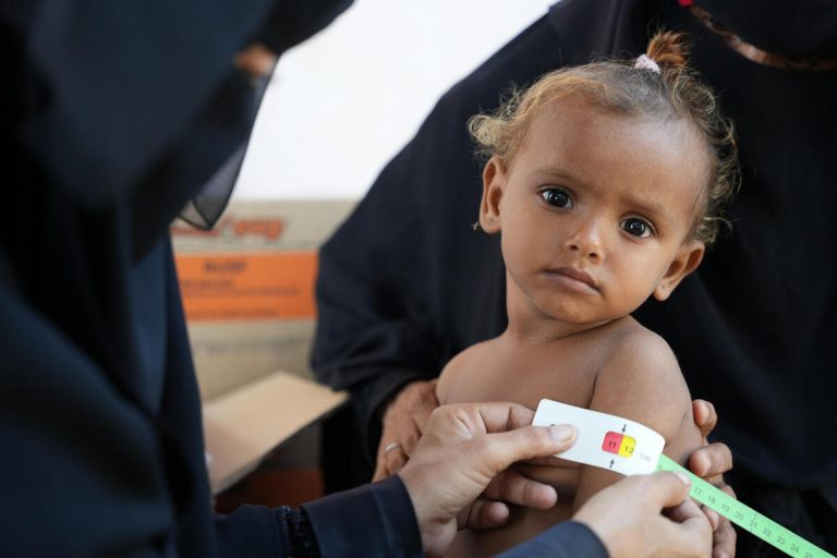 Otrok iz Hodajde v Jemnu med pregledom za ugotavljanje podhranjenosti. UNICEF s pomočjo partnerjev na terenu med drugim podpira delovanje ambulant in mobilnih klinik za preprečevanje, ugotavljanje in zdravljenje podhranjenosti.