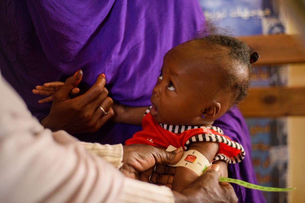 Pohranjena 1-letna Mawada med pregledom v zdravstvenem centru Dar Al-Salam v Port Sudanu. S trakom za merjenje podhranjenosti ji merijo nadlaht. Slednji kaže podhranjenost.